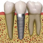 single dental implant next to natural teeth